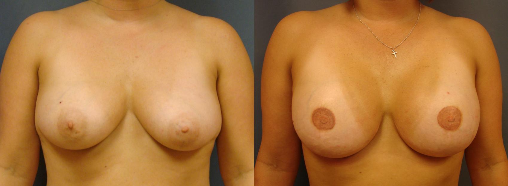Before & After Breast Reconstruction Case 64 View #1 View in Birmingham, AL
