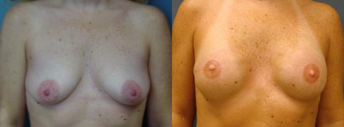 Before & After Breast Reconstruction Case 65 View #1 View in Birmingham, AL