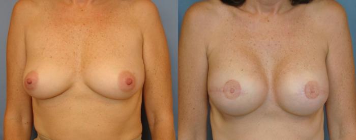 Before & After Breast Reconstruction Case 75 View #1 View in Birmingham, AL