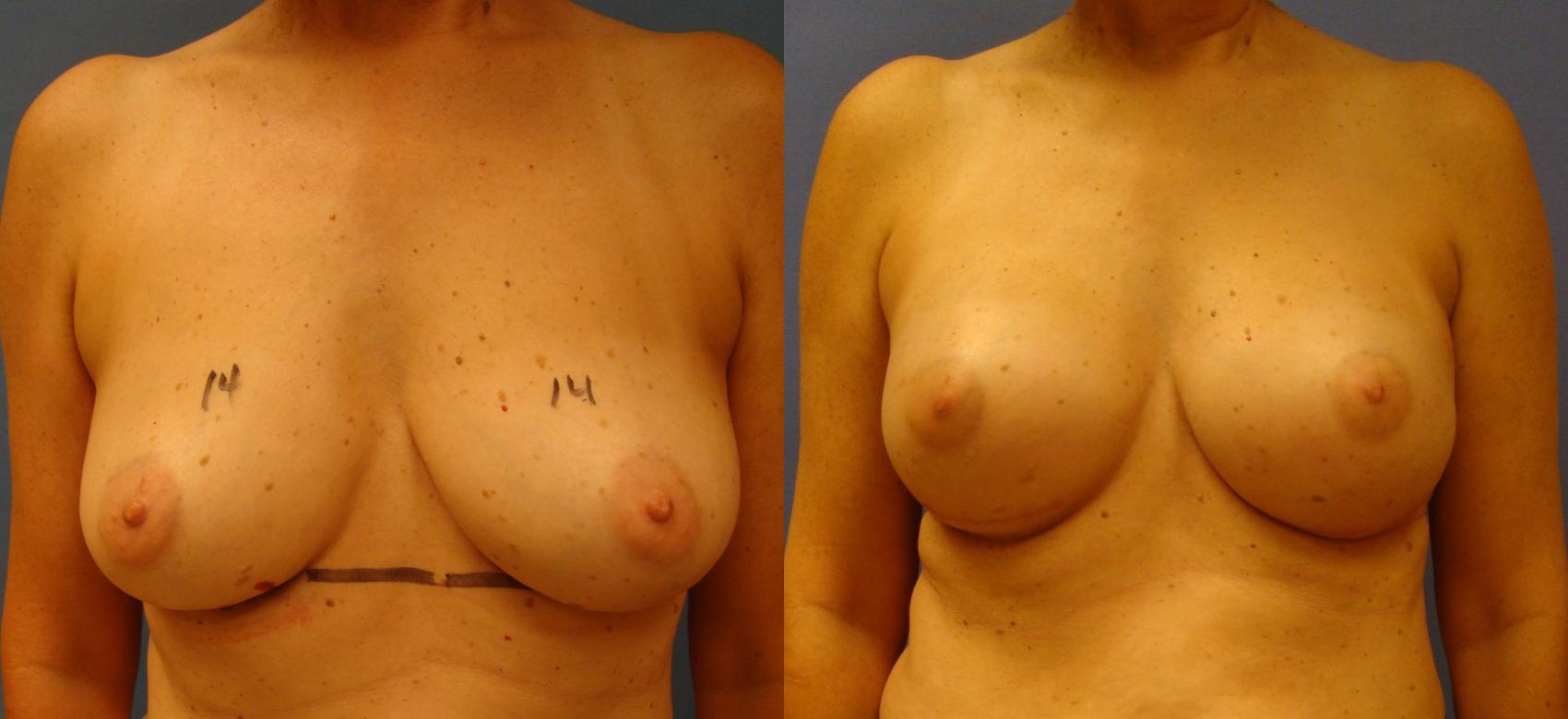 Before & After Breast Reconstruction Case 87 View #1 View in Birmingham, AL