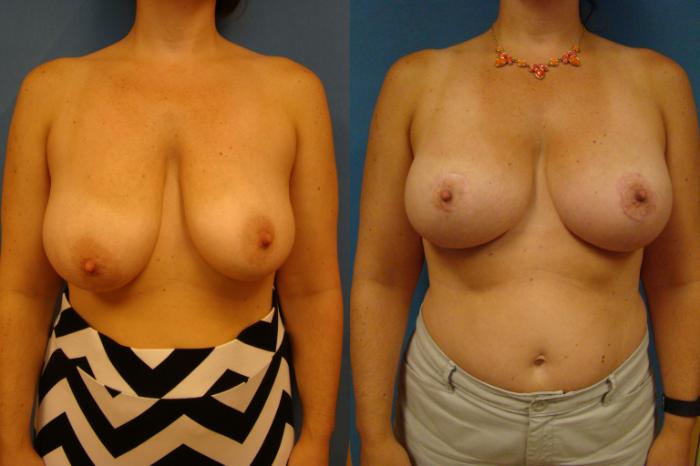 Before & After Breast Reconstruction Case 88 View #1 View in Birmingham, AL