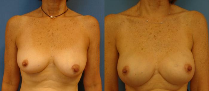 Before & After Breast Reconstruction Case 89 View #1 View in Birmingham, AL