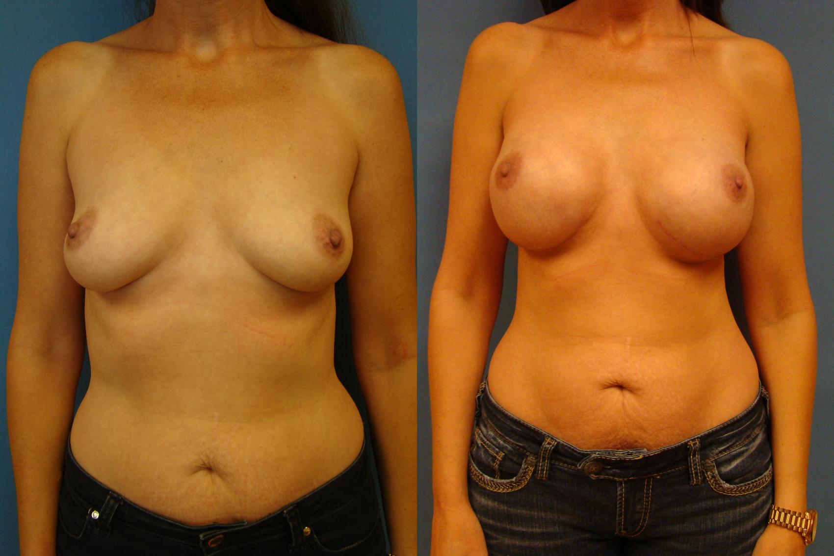 Before & After Breast Reconstruction Case 90 View #1 View in Birmingham, AL