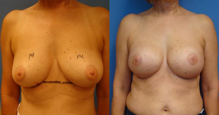 Before & After Breast Reconstruction Case 91 View #1 View in Birmingham, AL
