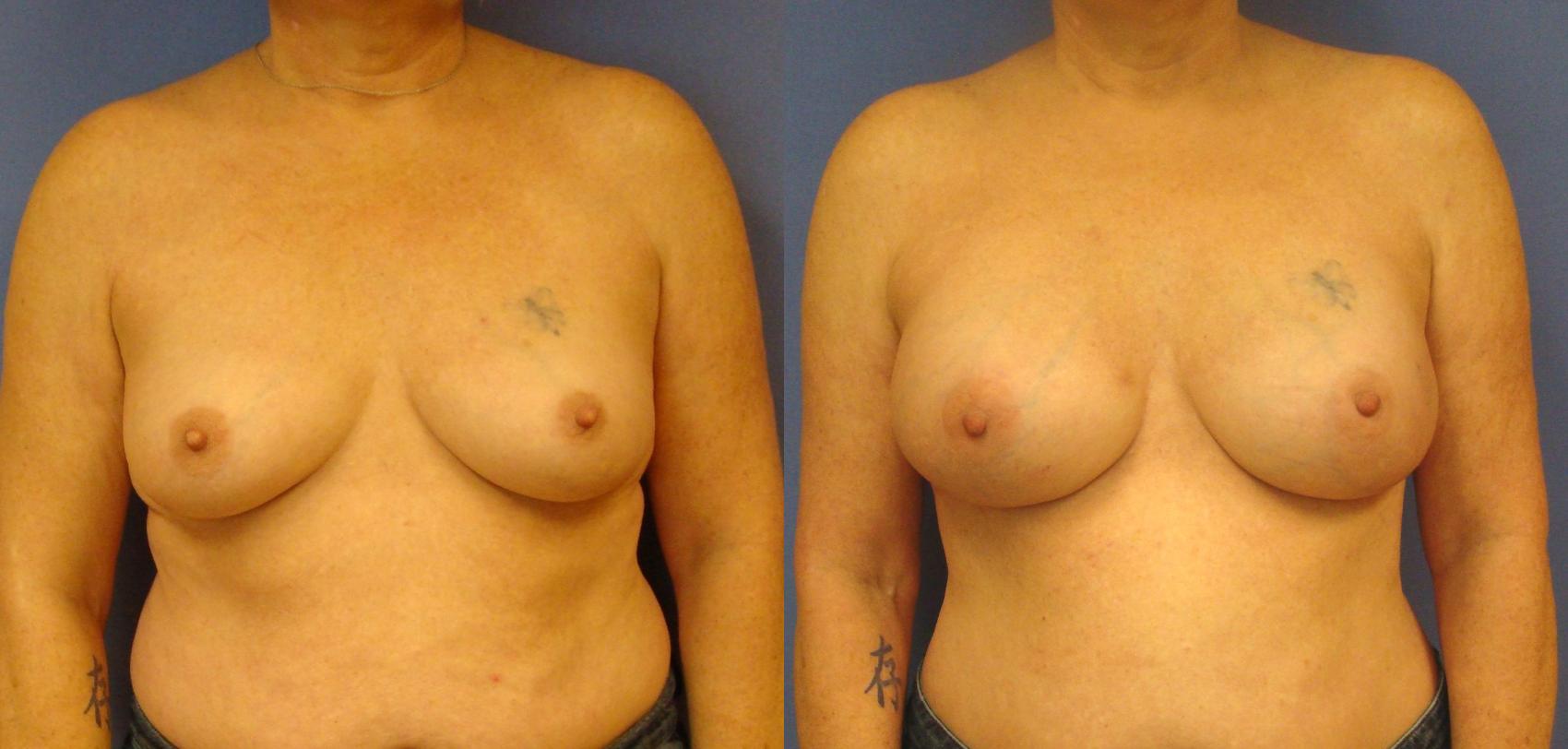 Before & After Breast Reconstruction Case 92 View #1 View in Birmingham, AL