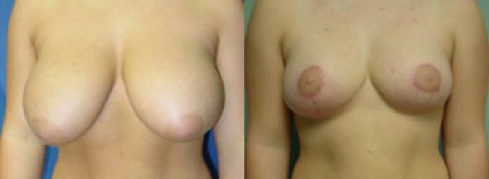 Before & After Breast Reduction Case 11 View #1 View in Birmingham, AL
