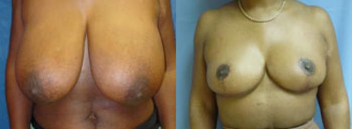 Before & After Breast Reduction Case 12 View #1 View in Birmingham, AL