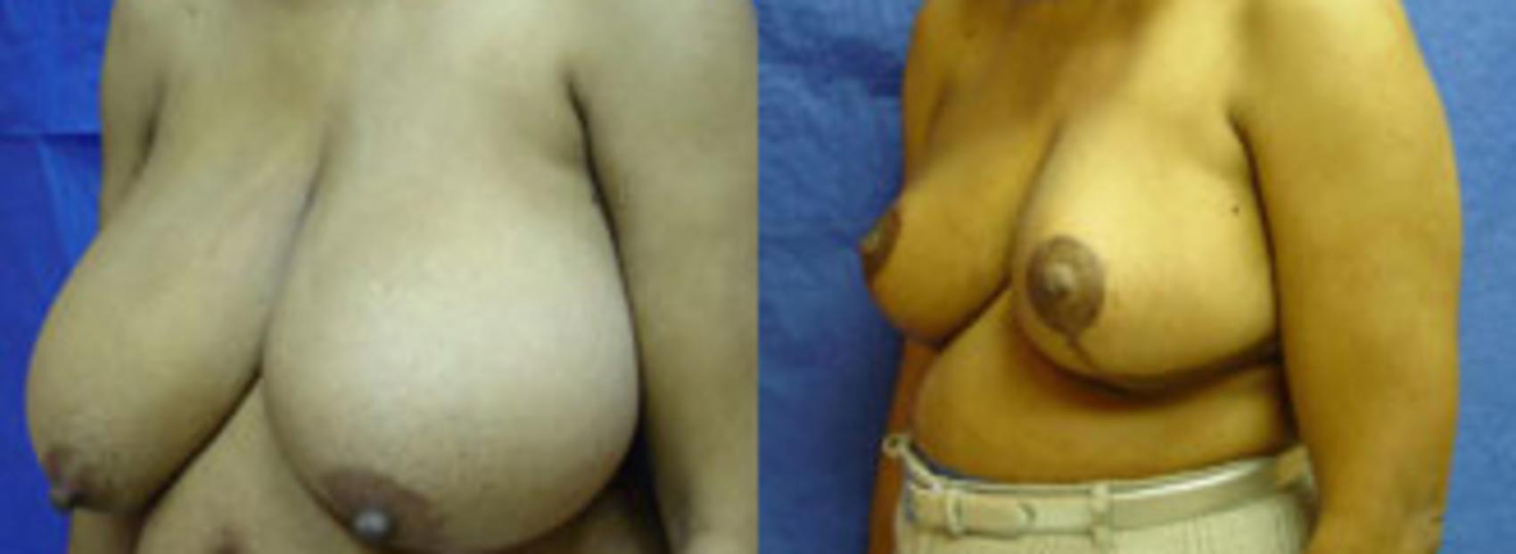Before & After Breast Reduction Case 14 View #1 View in Birmingham, AL