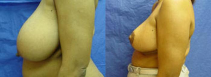 Before & After Breast Reduction Case 15 View #1 View in Birmingham, AL