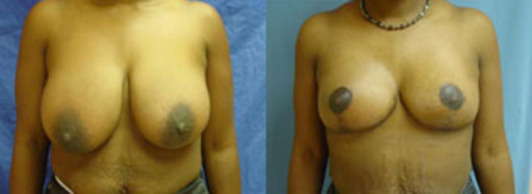 Before & After Breast Reduction Case 16 View #1 View in Birmingham, AL