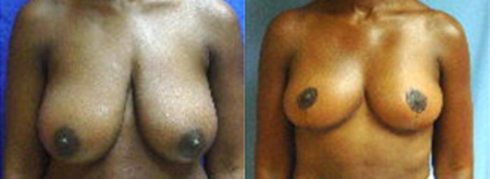 Before & After Breast Reduction Case 17 View #1 View in Birmingham, AL