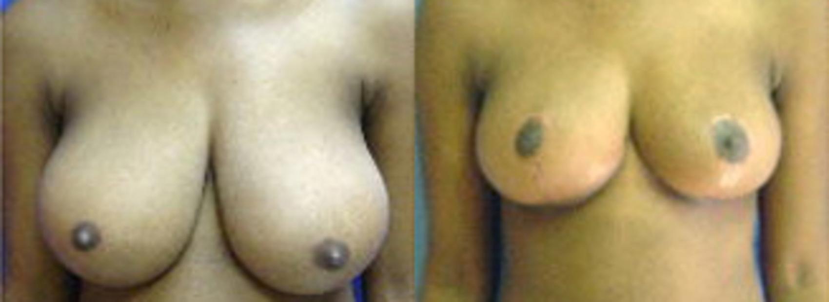 Before & After Breast Reduction Case 18 View #1 View in Birmingham, AL