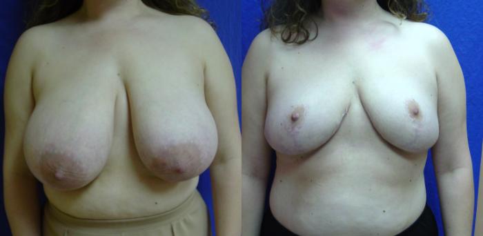 Before & After Breast Reduction Case 26 View #1 View in Birmingham, AL