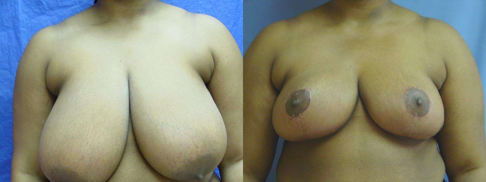 Before & After Breast Reduction Case 29 View #1 View in Birmingham, AL
