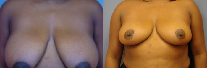 Before & After Breast Reduction Case 30 View #1 View in Birmingham, AL