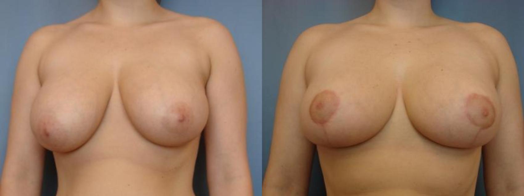 Before & After Breast Reduction Case 57 View #1 View in Birmingham, AL