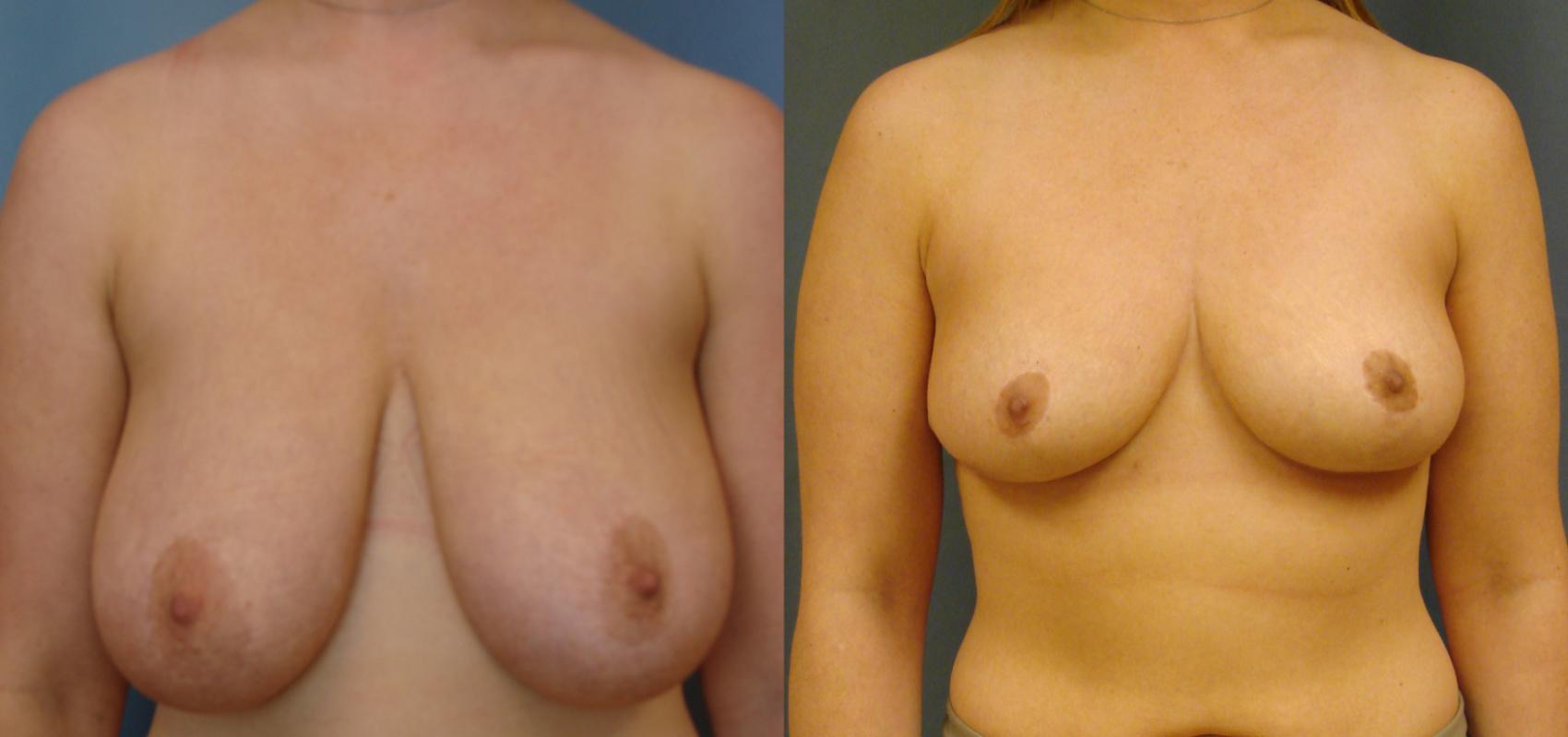 Before & After Breast Reduction Case 66 View #1 View in Birmingham, AL