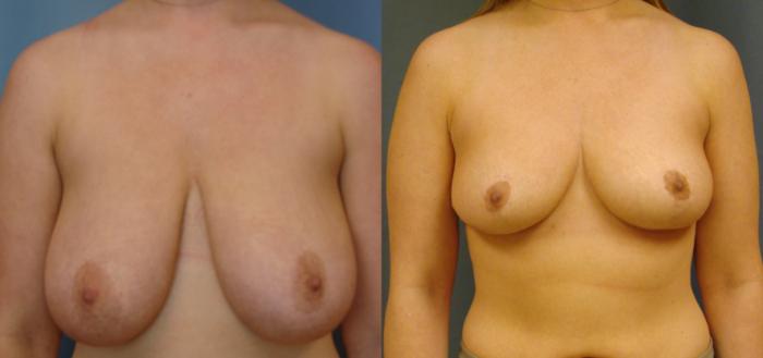 Before & After Breast Reduction Case 66 View #1 View in Birmingham, AL