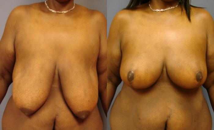 Before & After Breast Reduction Case 67 View #1 View in Birmingham, AL