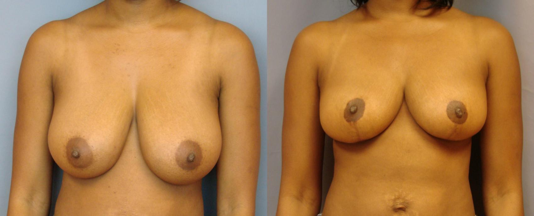 Before & After Breast Reduction Case 78 View #1 View in Birmingham, AL