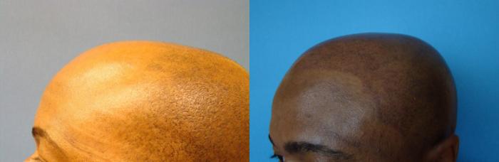 Before & After Micropigmentation Case 104 Left Side View in Birmingham, AL