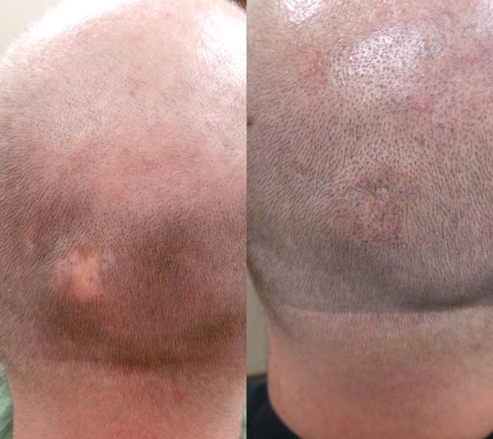 Before & After Micropigmentation Case 105 Back View in Birmingham, AL
