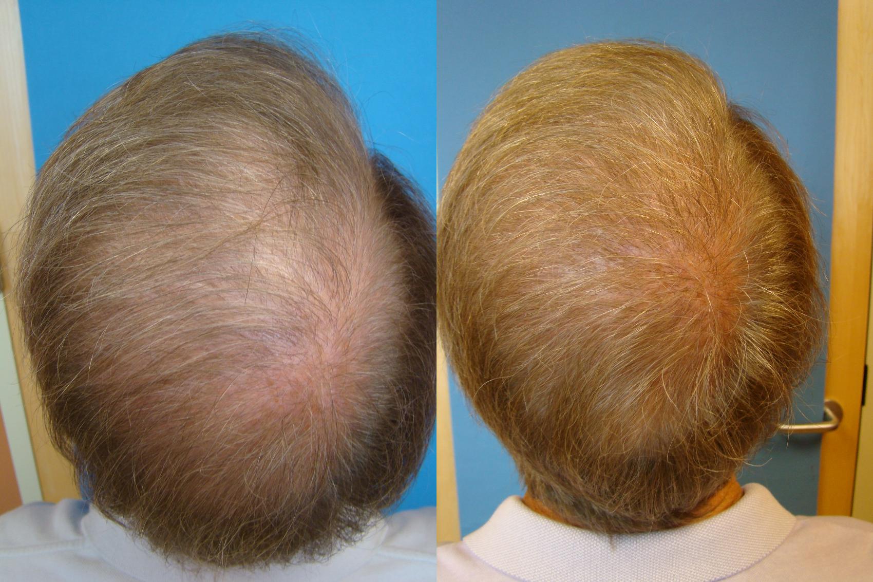 Before & After Neograft Hair Replacement Case 106 Back View in Birmingham, AL