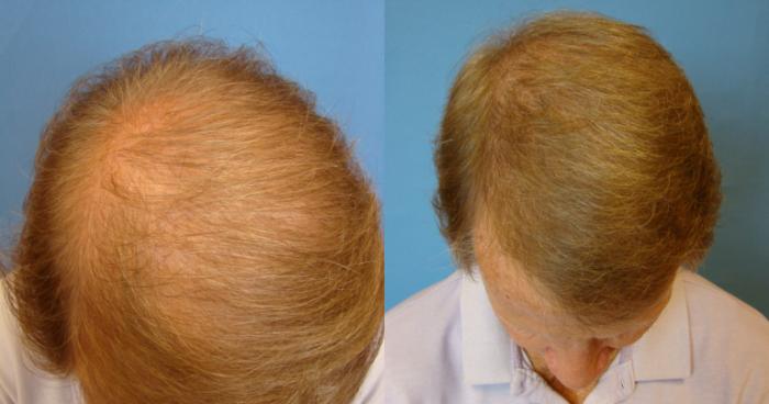 Before & After Neograft Hair Replacement Case 106 Front View in Birmingham, AL