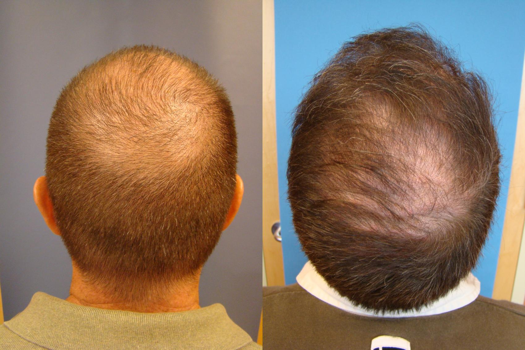 Before & After Neograft Hair Replacement Case 107 Back View in Birmingham, AL