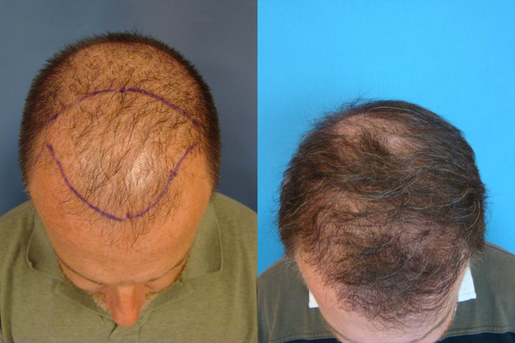 Before & After Neograft Hair Replacement Case 107 Front View in Birmingham, AL