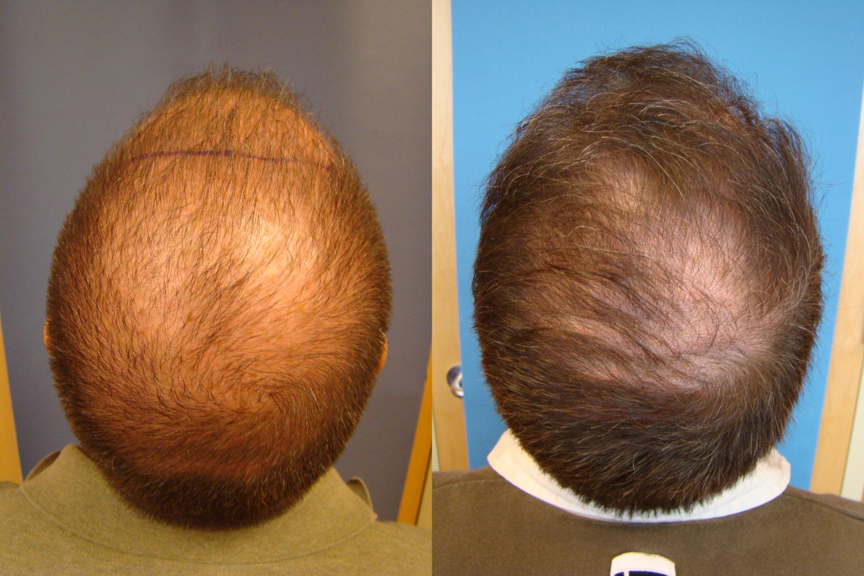 Before & After Neograft Hair Replacement Case 107 Top Back View in Birmingham, AL