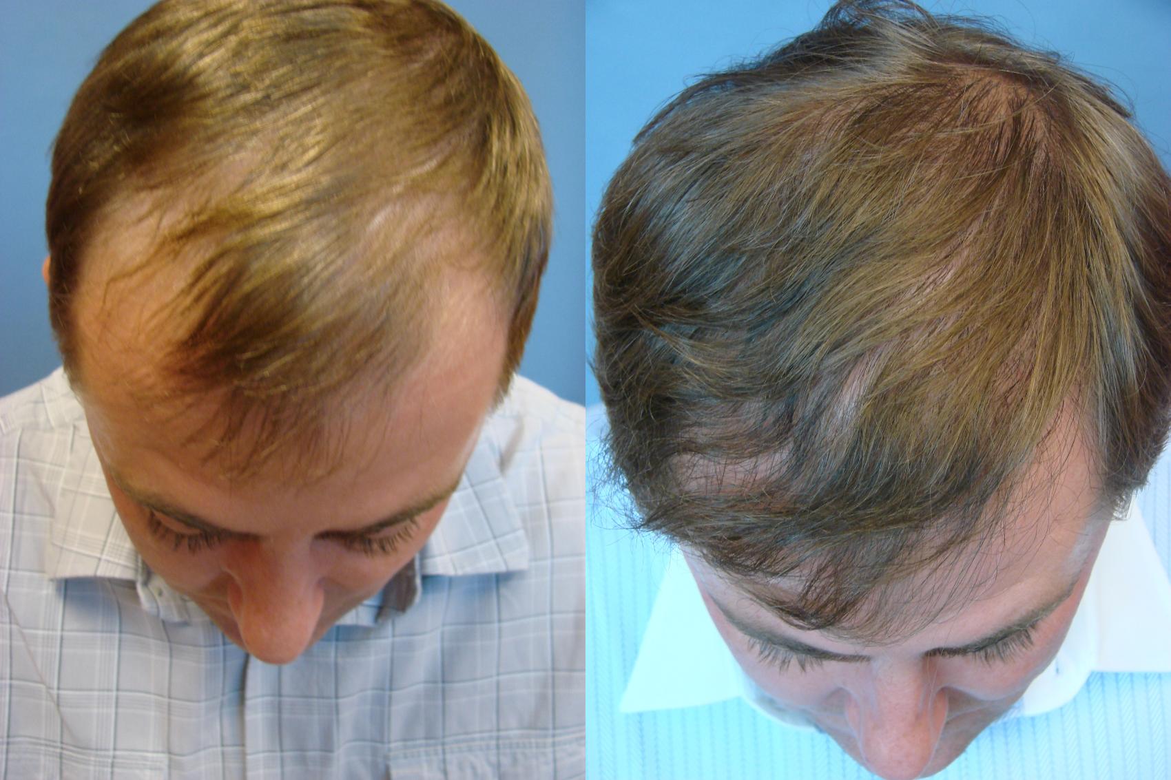 1000 Grafts Hair Transplant: Coverage, Costs, Results