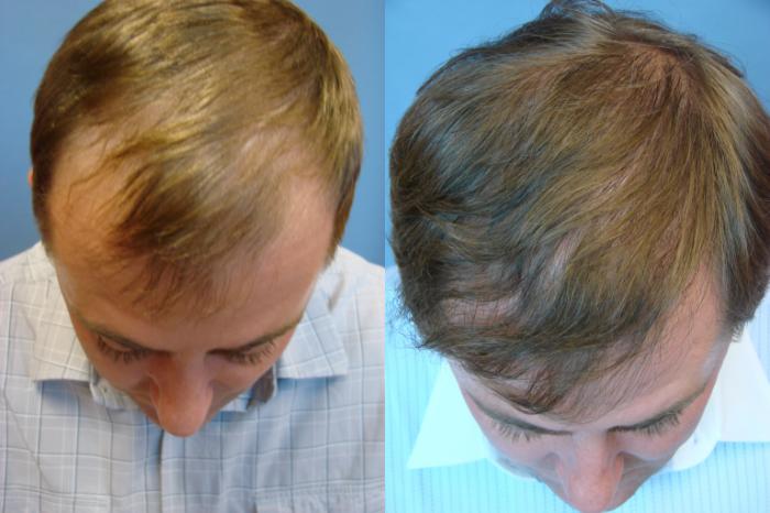 Before & After Neograft Hair Replacement Case 108 Front View in Birmingham, AL