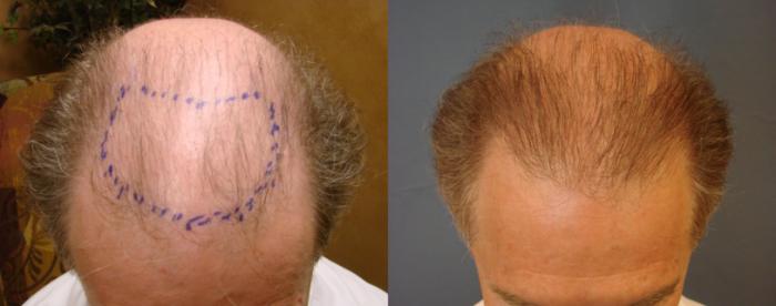 Before & After Neograft Hair Replacement Case 82 View #1 View in Birmingham, AL