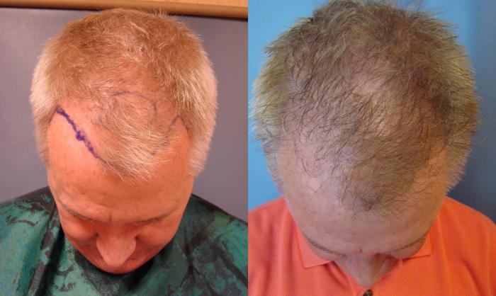 Before & After Neograft Hair Replacement Case 83 View #1 View in Birmingham, AL