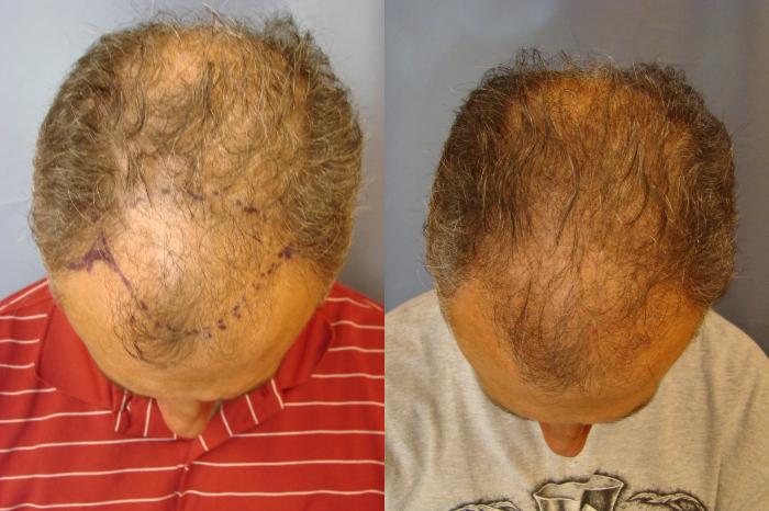 Before & After Neograft Hair Replacement Case 84 View #1 View in Birmingham, AL