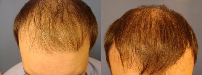 Before & After Neograft Hair Replacement Case 86 View #1 View in Birmingham, AL