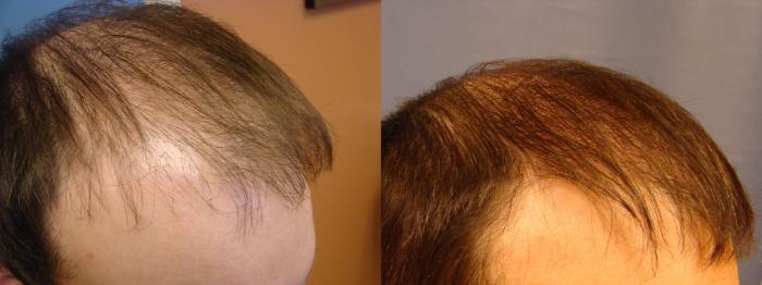 Before & After Neograft Hair Replacement Case 86 View #2 View in Birmingham, AL