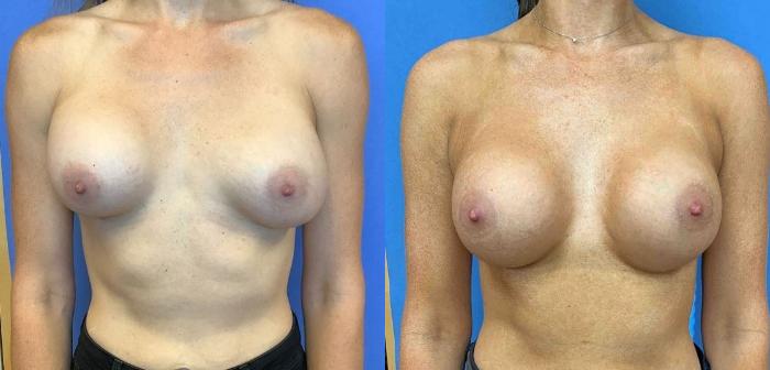 Pre-Operative Revision of Breast Augmentation