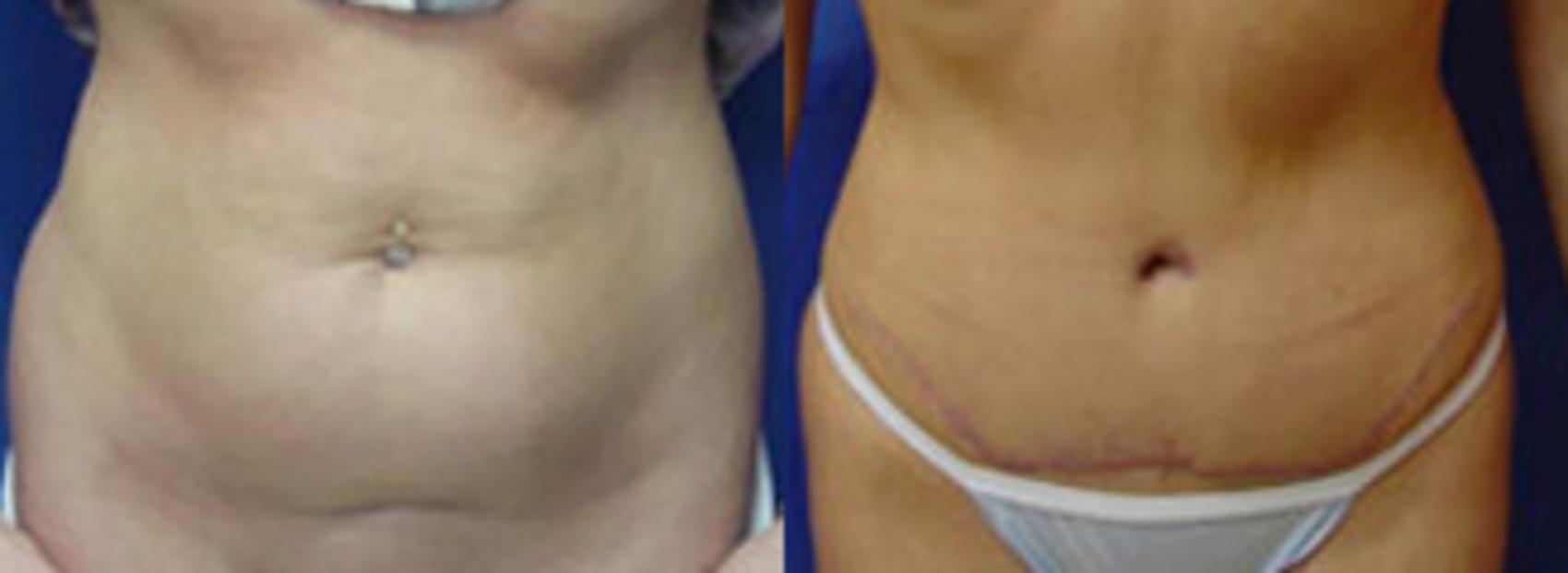 Before & After Tummy Tuck Case 1 View #1 View in Birmingham, AL