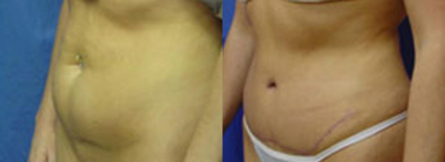 Before & After Tummy Tuck Case 1 View #2 View in Birmingham, AL