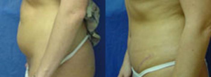 Before & After Tummy Tuck Case 1 View #3 View in Birmingham, AL