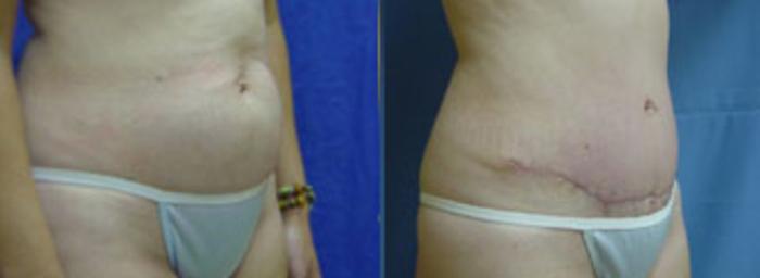 Before & After Tummy Tuck Case 102 View #2 View in Birmingham, AL