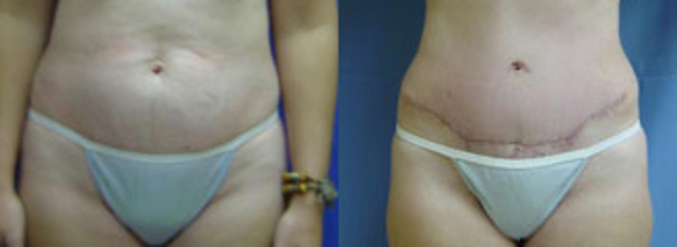 Before & After Tummy Tuck Case 102 View #1 View in Birmingham, AL