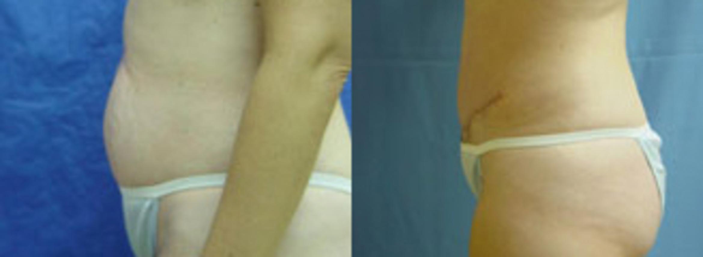 Before & After Tummy Tuck Case 102 View #3 View in Birmingham, AL