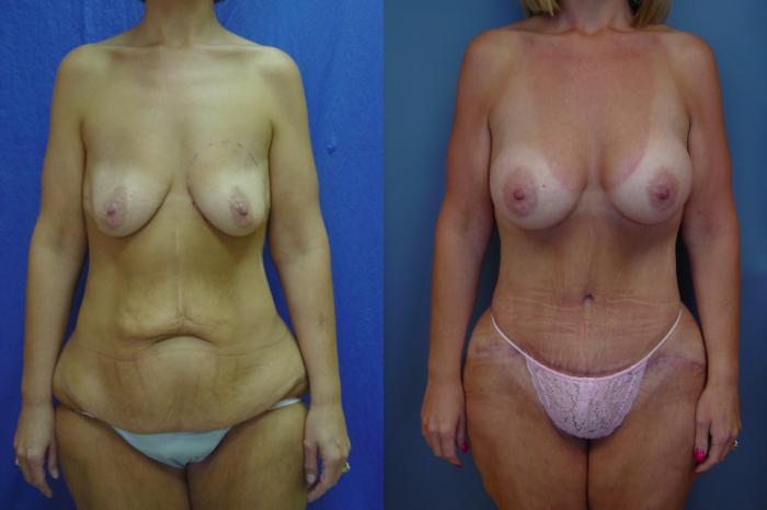 Before & After Tummy Tuck Case 20 View #1 View in Birmingham, AL