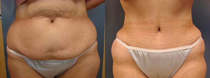 Before & After Tummy Tuck Case 38 View #1 View in Birmingham, AL