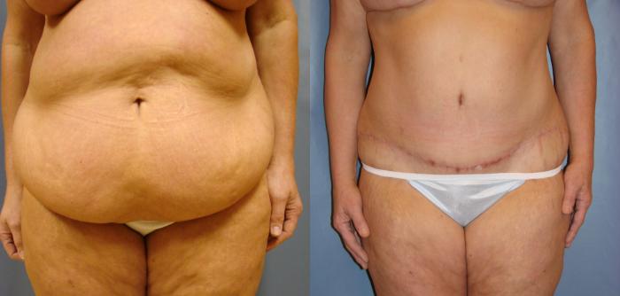 Before & After Tummy Tuck Case 40 View #1 View in Birmingham, AL