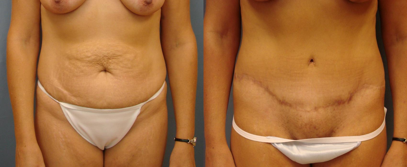 Before & After Tummy Tuck Case 51 View #1 View in Birmingham, AL