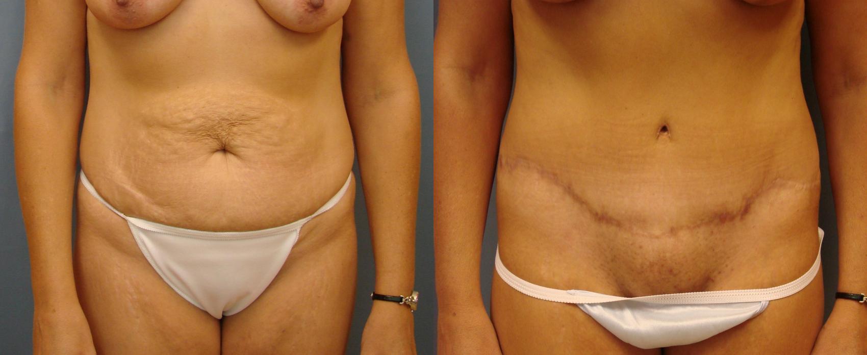 Is it Easier to Lose Weight After a Tummy Tuck? - Restore SD Plastic Surgery